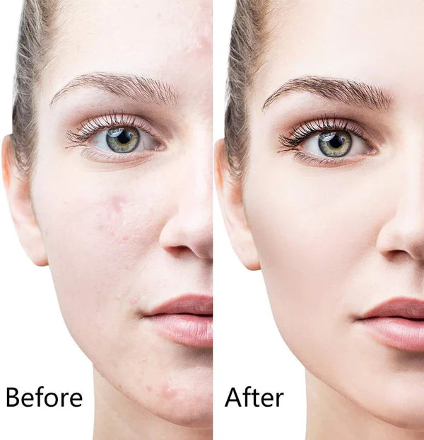 Zeenah™ 6-in-1 Derma Roller System | زينة™ نظام ديرما رولر 6 في 1